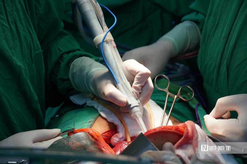 Cần Thơ: Lần đầu tiên sử dụng dao mổ siêu âm CUSA trong phẫu thuật cắt gan - Ảnh 1.