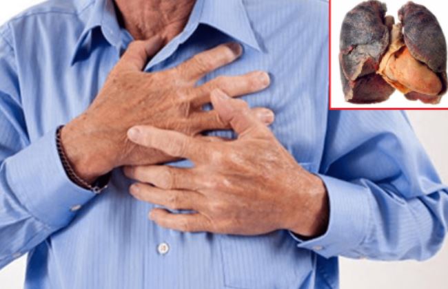 Người đàn ông 55 tuổi phát hiện cùng lúc 2 loại ung thư từ triệu chứng "lạ" khi ăn - Ảnh 1.