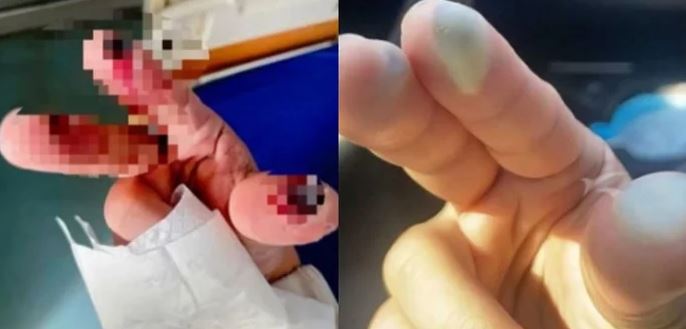 Người phụ nữ 52 tuổi tử vong sau 5 ngày làm vỡ thùng "nước lạ" - Ảnh 2.