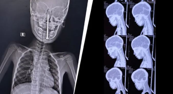 Phẫu thuật cho bé trai 7 tuổi, bác sĩ sốc nặng khi lấy ra "thứ đáng sợ" - Ảnh 1.