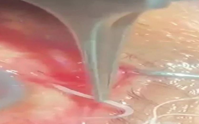 Bụng bỗng phình to, cô gái 19 tuổi sốc khi biết "thứ đáng sợ" bên trong - Ảnh 2.