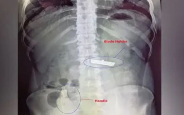 Bé trai 11 tuổi đau cổ, khó thở sau ăn bánh, bác sĩ gắp thứ "đáng sợ" bên trong - Ảnh 2.