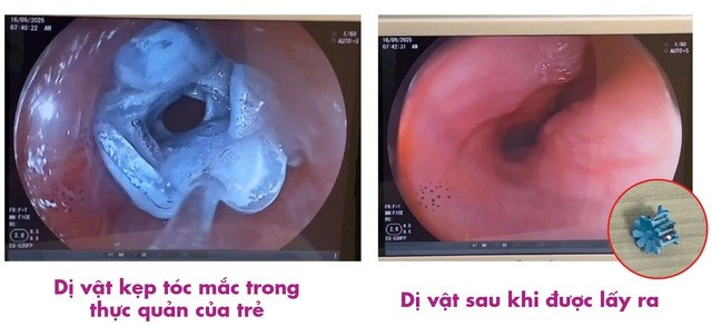 Bé gái 5 tuổi đau rát họng, bác sĩ gắp ra "thứ đáng sợ" bên trong - Ảnh 2.
