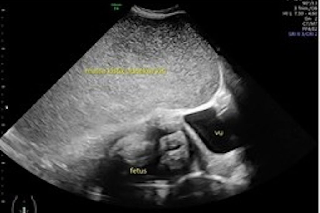 Siêu âm cho thai phụ, bác sĩ sốc nặng khi thấy thứ bên trong - Ảnh 1.