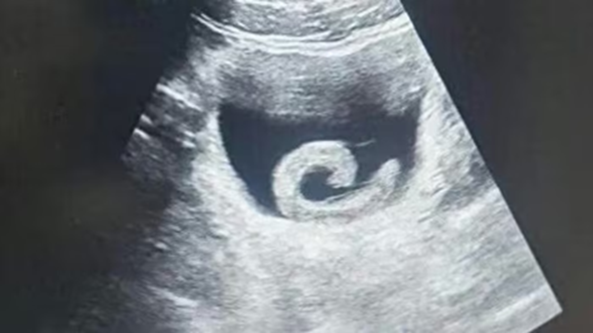 Đi siêu âm, người đàn ông sốc nặng khi thấy đỉa sống trong bụng mình - Ảnh 1.