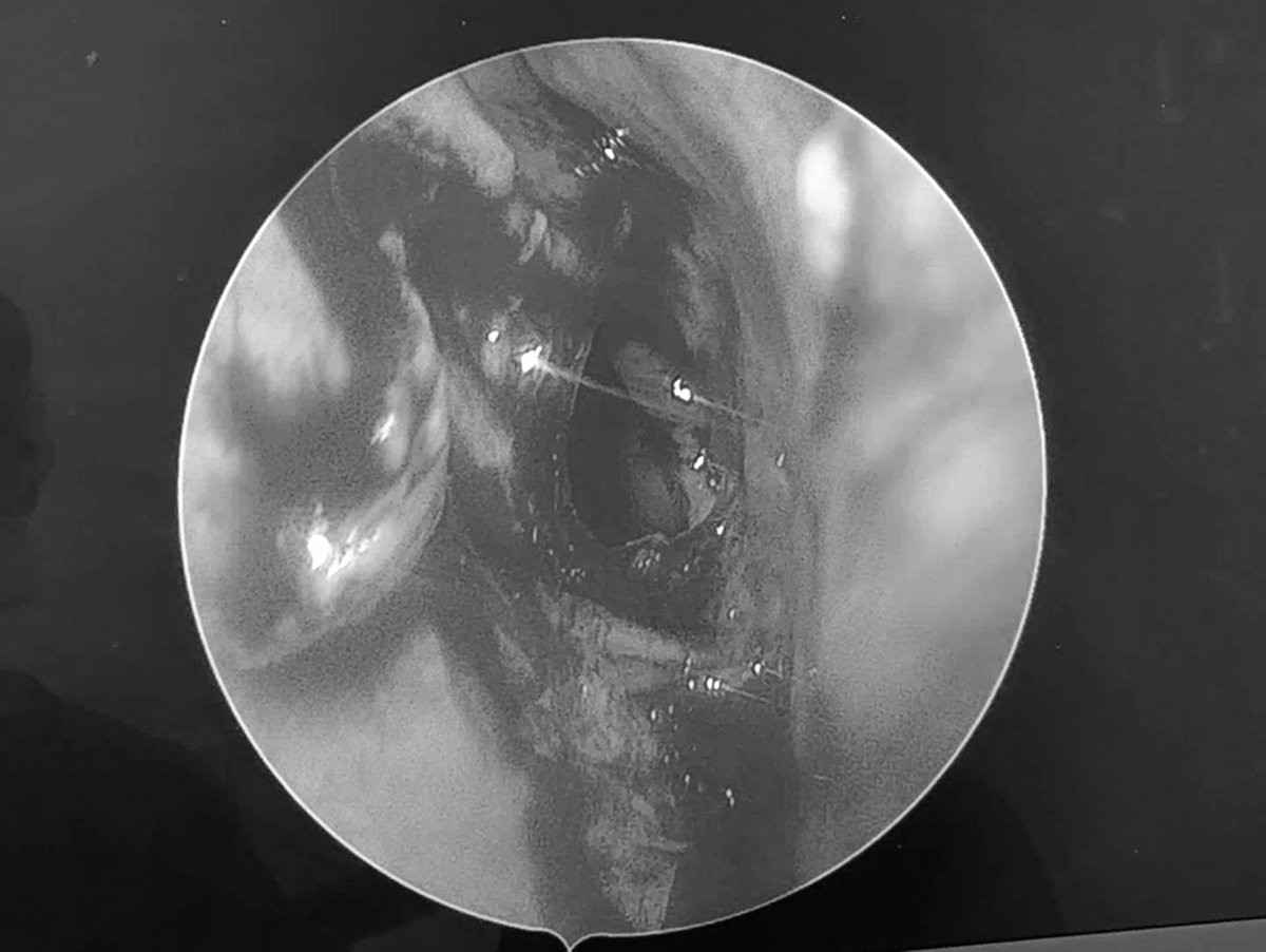 Đi khám, người đàn ông sốc nặng khi bác sĩ thấy thứ "đáng sợ" trong mũi mình- Ảnh 1. Đi khám, người đàn ông sốc nặng khi bác sĩ thấy thứ "đáng sợ" trong mũi mình- Ảnh 1.