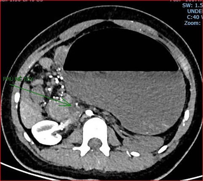 Ca bệnh tử vong gây dư luận trái chiều: Bệnh viện thông tin sự việc- Ảnh 4.