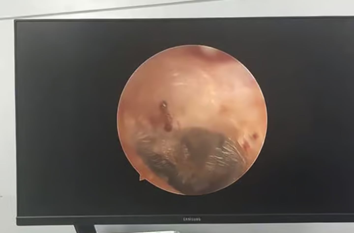 Nghe thấy âm thanh lạ trong tai, người phụ nữ đi khám thì sốc nặng- Ảnh 1.