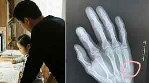 Tức giận khi dạy con làm bài tập, bố tức giận đập bàn gãy tay - Ảnh 1.