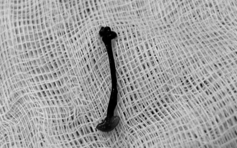 B&eacute; trai 4 tuổi rỉ m&aacute;u mũi k&eacute;o d&agrave;i, b&aacute;c sĩ gắp ra thứ "đ&aacute;ng sợ" b&ecirc;n trong - Ảnh 2.