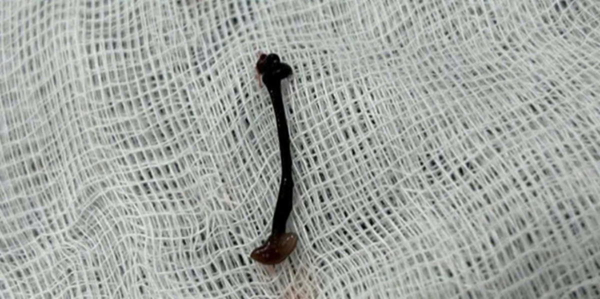 Bé trai hơn 2 tuổi chảy nước mũi kéo dài, bác sĩ gắp ra thứ "đáng sợ" bên trong - Ảnh 1.