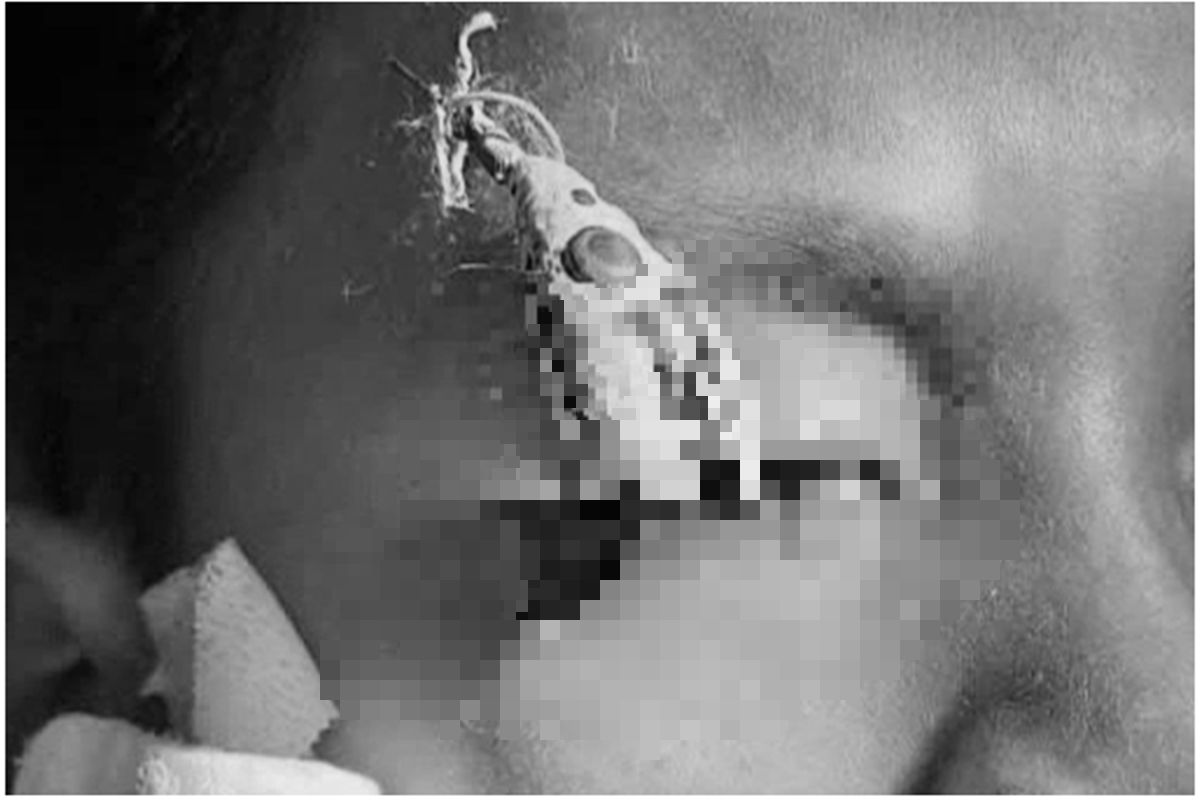 Bé trai 12 tuổi đau mắt dữ dội, bác sĩ gắp ra thứ "đáng sợ" bên trong - Ảnh 1.