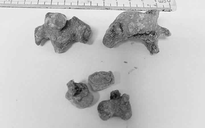 B&eacute; trai 13 tuổi chảy m&aacute;u nhiều, b&aacute;c sĩ sốc khi ph&aacute;t hiện b&iacute; mật "đ&aacute;ng sợ" ở cổ - Ảnh 3.