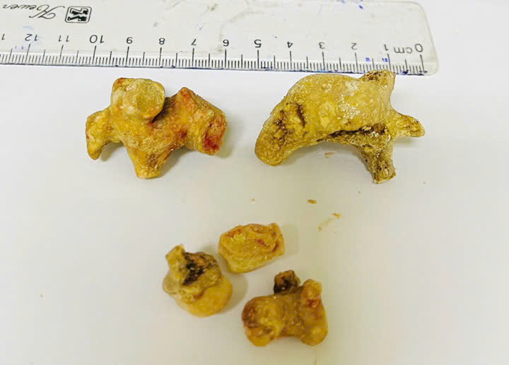 Người phụ nữ 55 tuổi bụng "cứng như đá", bác sĩ phát hiện bí mật "đáng sợ" - Ảnh 1.