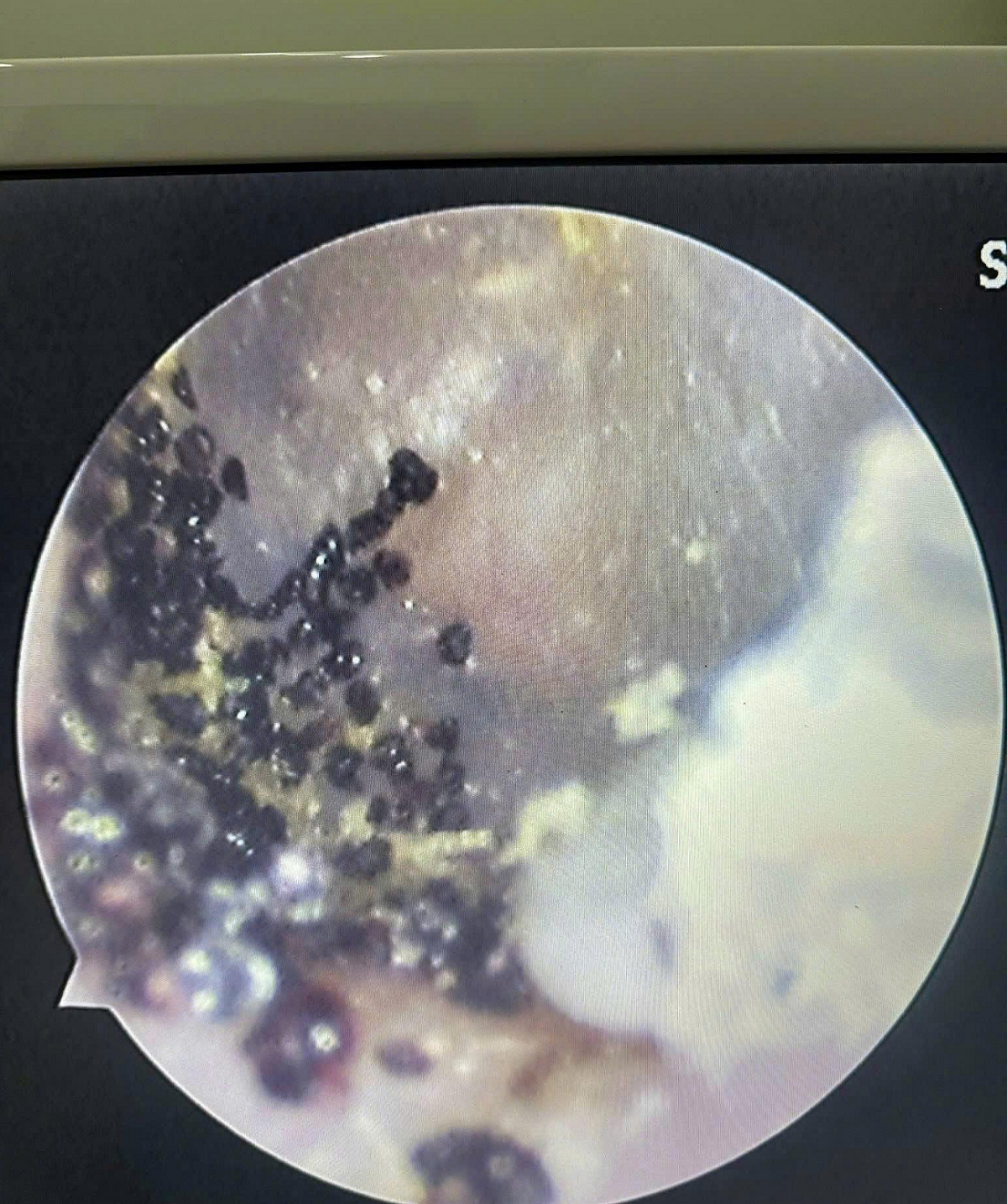 Nghe thấy âm thanh lạ trong tai, bé 7 tuổi đi khám thì sốc nặng - Ảnh 1.