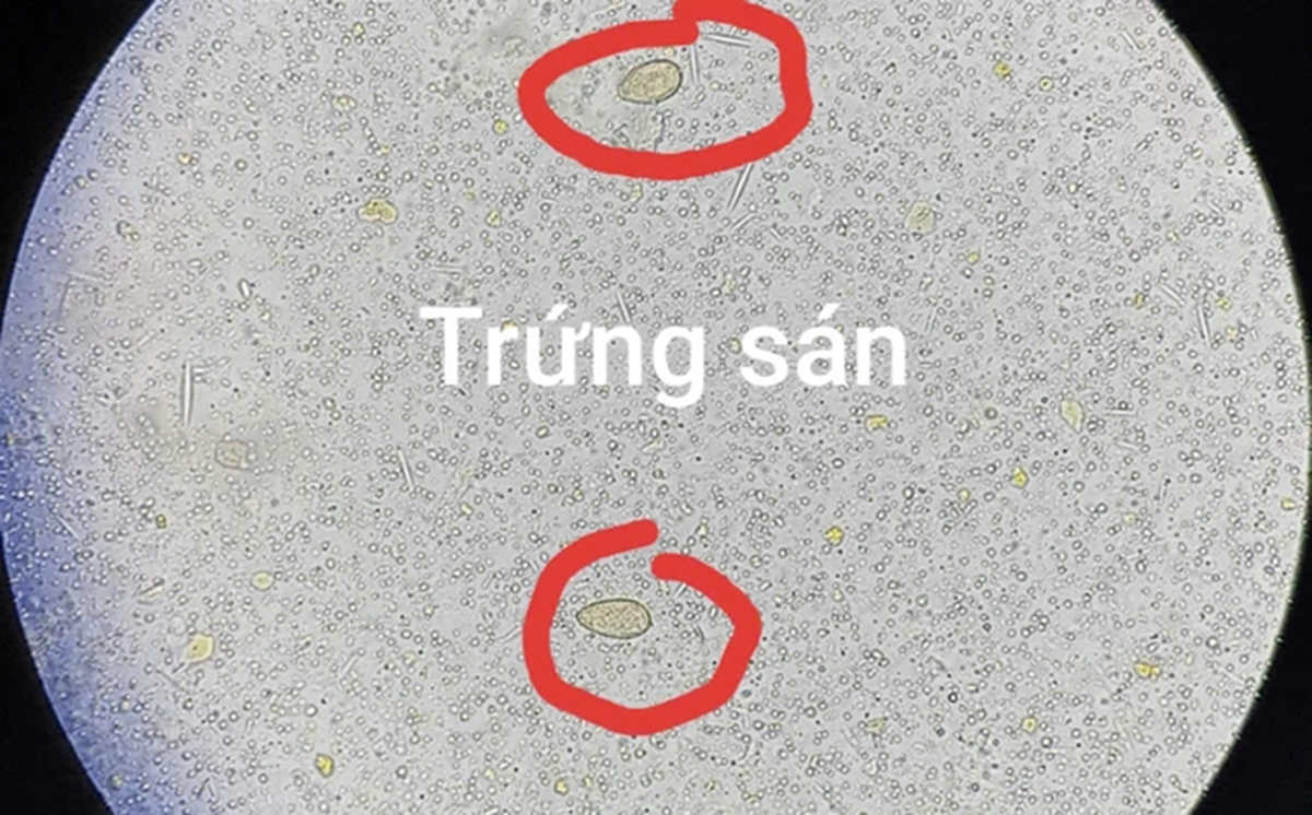 Đau bụng đi khám, người đàn ông 64 tuổi sốc ngang khi thấy ở sán trong người - Ảnh 1.