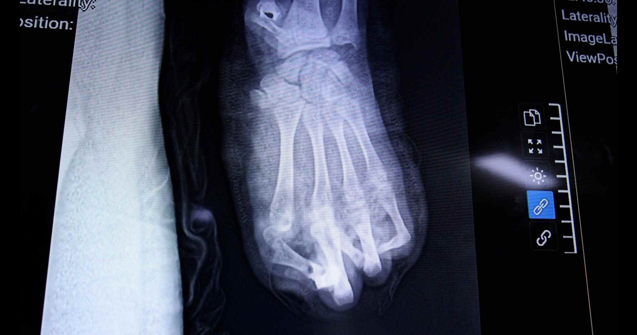 Nam thiếu niên 15 tuổi nguy cơ mất bàn tay vì pháo nổ - Ảnh 1.