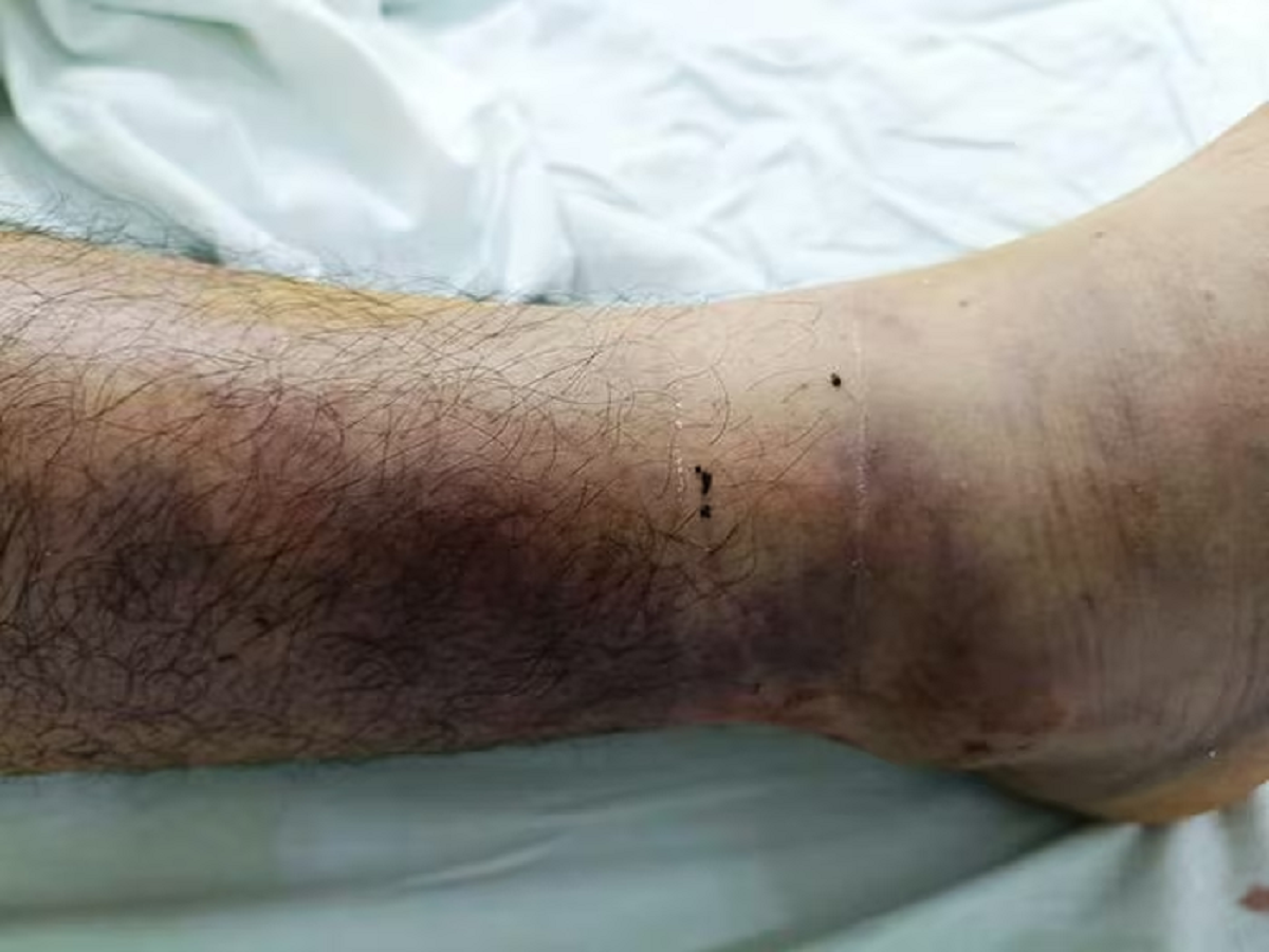 Đi làm rẫy, nam thanh niên 19 tuổi bị con vật quen thuộc đuôi đỏ cắn nguy khiểm - Ảnh 1.