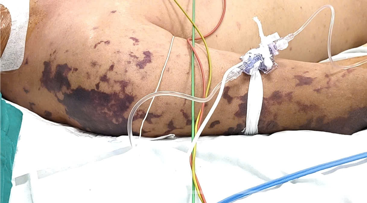 Ăn thịt lợn ở đám cỗ, người đàn ông 52 tuổi lơ mơ, nguy kịch - Ảnh 2.