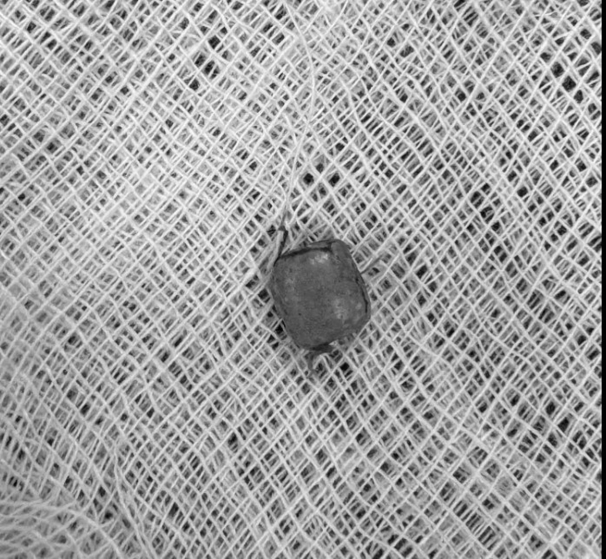 Bé 10 tuổi ù tai kéo dài, bác sĩ gắp ra thứ "đáng sợ" bên trong - Ảnh 1.