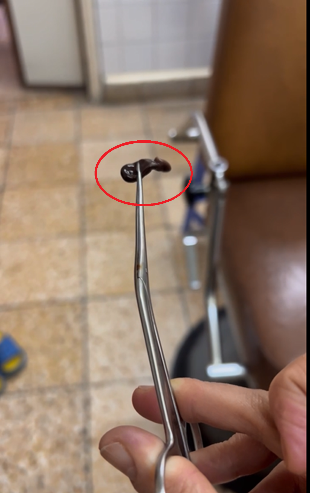 Bé trai 4 tuổi rỉ máu mũi, bác sĩ gắp ra thứ "đáng sợ" bên trong - Ảnh 1.