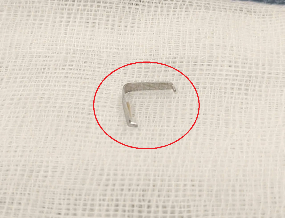 Bé trai 1 tuổi cứ ăn là nôn ọe, bác sĩ phát hiện "bí mật" bên trong - Ảnh 2.