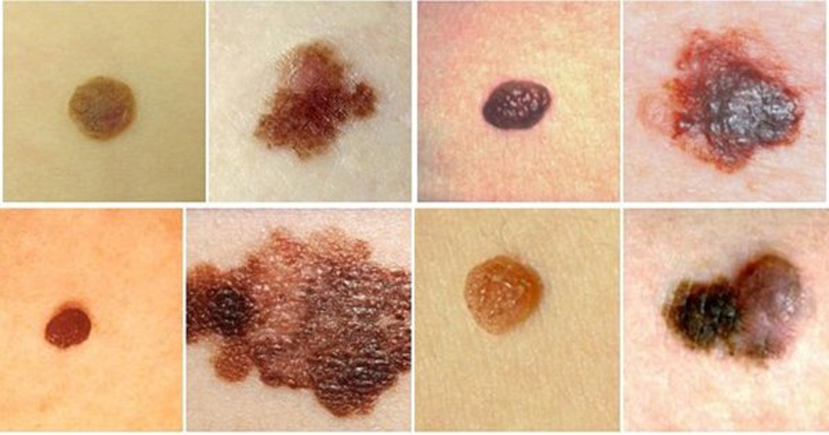 5 dấu hiệu nhận biết nốt ruồi có nguy cơ ác tính, ung thư, nhất cái số 1 không phải ai cũng biết - Ảnh 1.