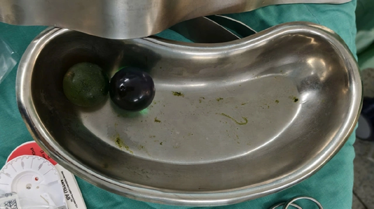 Bé gái 18 tháng tuổi nôn ói nguy kịch, bác sĩ gắp ra thứ "đáng sợ" trong bụng - Ảnh 1.