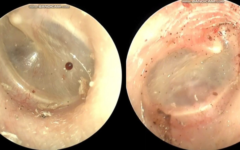 Người đ&agrave;n &ocirc;ng 73 tuổi "nghiện thứ đ&aacute;ng sợ", l&agrave;m tổn thương phổi, suy h&ocirc; hấp nặng - Ảnh 2.