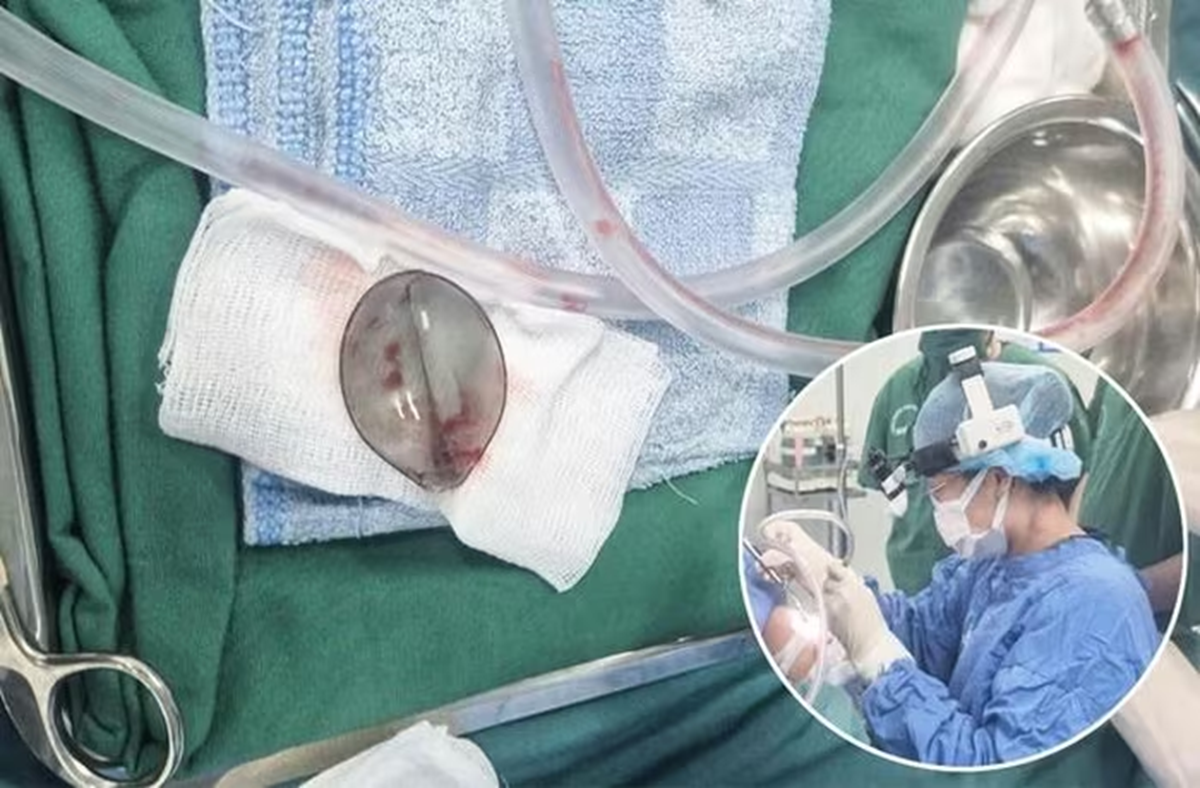 Bé 4 tuổi nôn ra máu, bác sĩ phát hiện thứ "đáng sợ" bên trong - Ảnh 1.