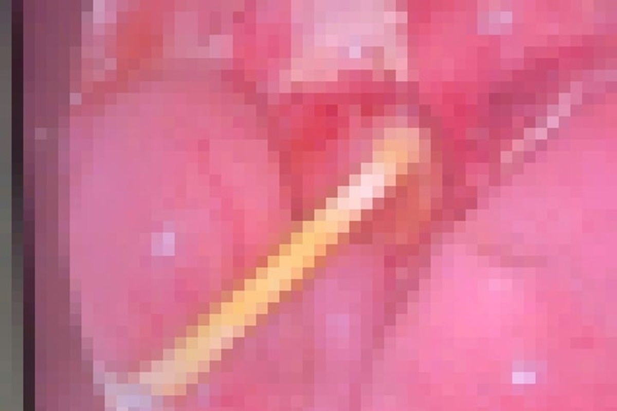 Bé 5 tuổi đau bụng kéo dài, gia đình sốc nặng khi bác sĩ gắp ra thứ "đáng sợ" trong bụng bé - Ảnh 1.