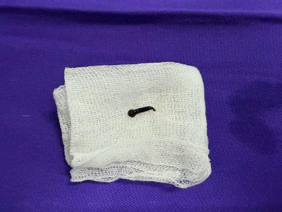 Cứ thấy vướng họng, người phụ nữ sốc khi bác sĩ gắp ra thứ 