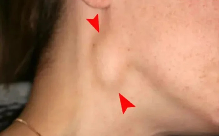 Dấu hiệu cảnh báo ung thư vòm họng tuyệt đối không nên bỏ qua - Ảnh 2.