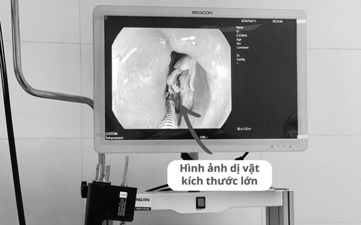 Cảnh báo nguy cơ hóc xương dịp Tết: Hai ca cấp cứu ở Hà Tĩnh và Hà Nội