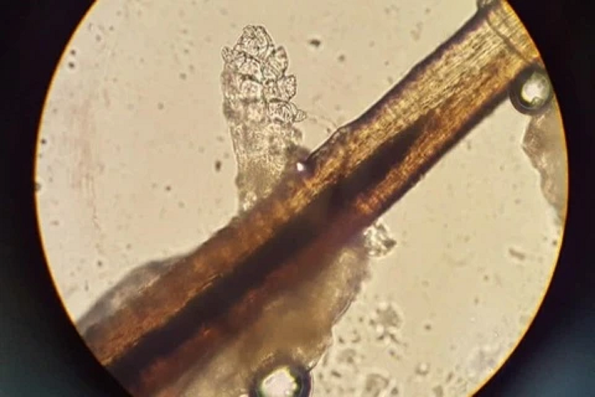 Người phụ nữ 24 tuổi khó chịu ở mí mắt, bác sĩ sốc khi gắp ra thứ "đáng sợ" chi chít trên mi- Ảnh 1.