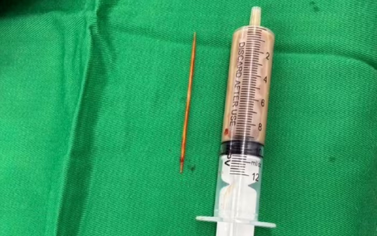 Bác sĩ Khánh Hòa phẫu thuật thành công cứu bệnh nhân nuốt tăm tre xuyên tá tràng, thủng thận