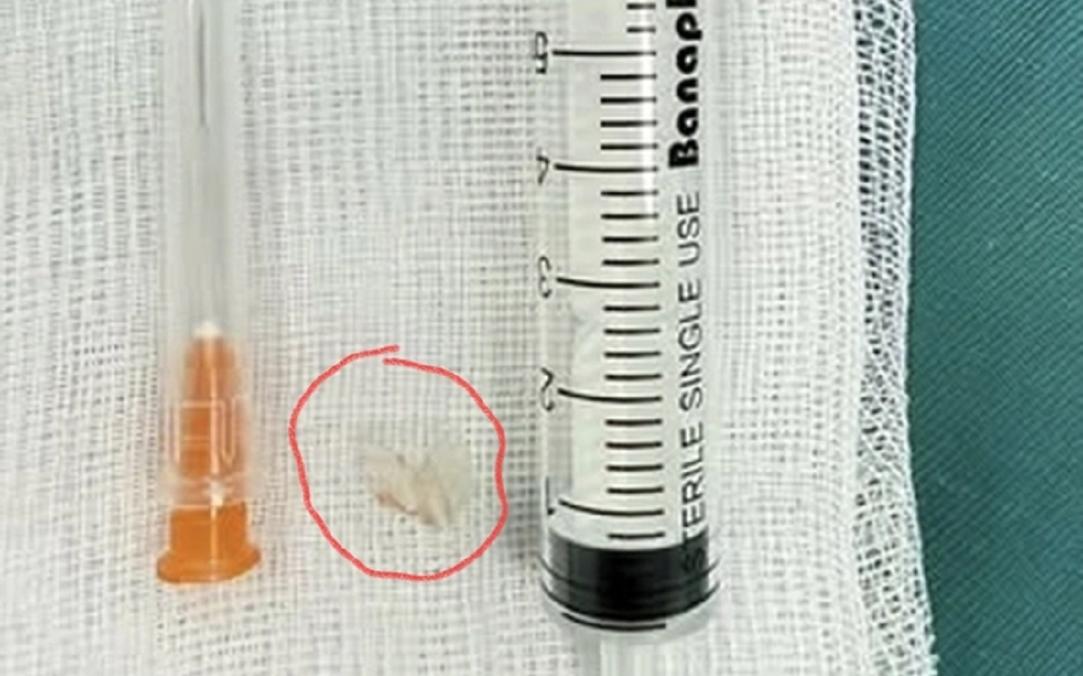 Bé trai đau vùng mắt dữ dội, bác sĩ sốc khi phát hiện bí mật "đáng sợ" bên trong - Ảnh 2.