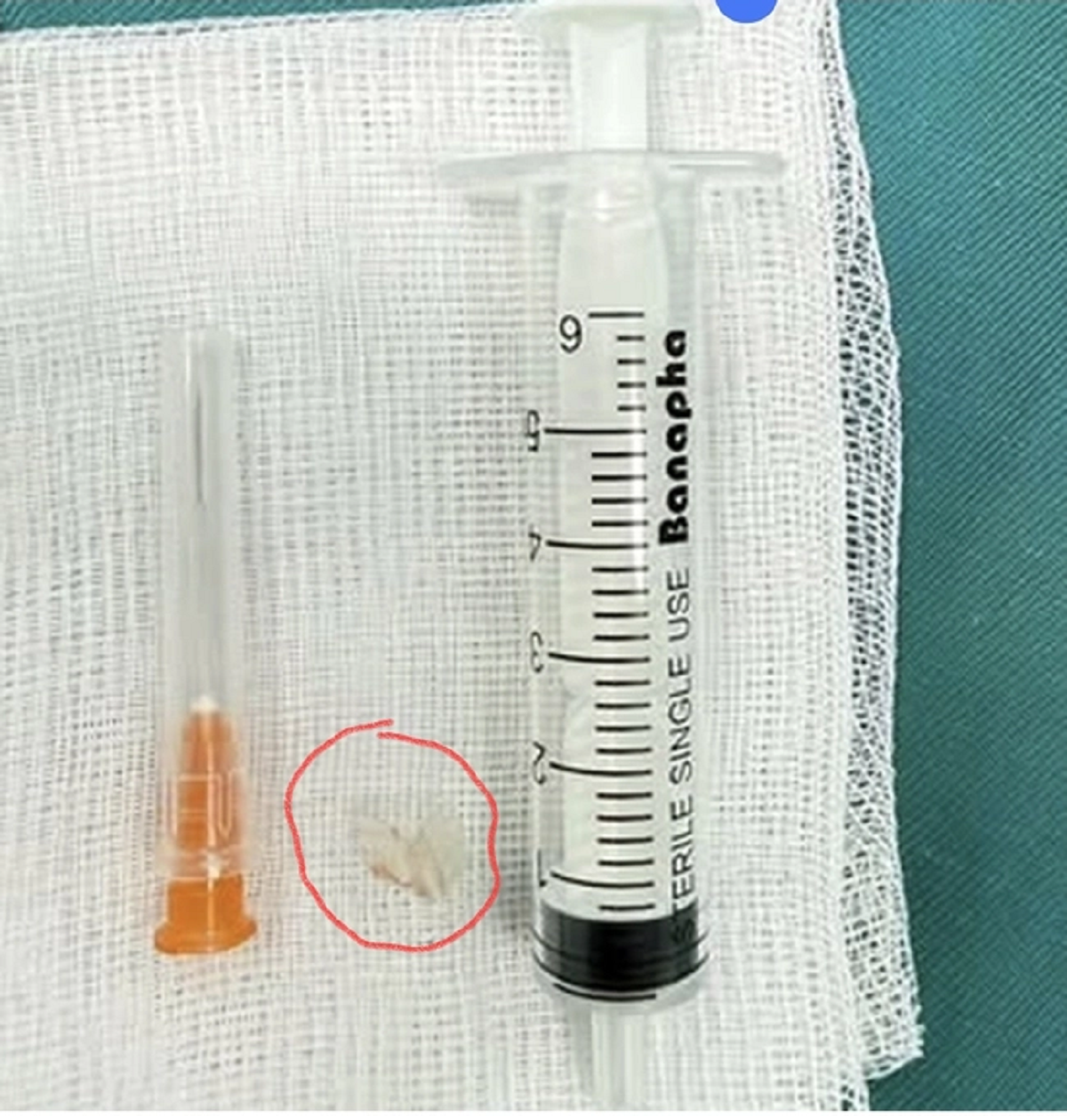 Bé trai 7 tuổi xẹp phổi trái, bác sĩ gắp ra thứ "đáng sợ" bên trong- Ảnh 1.