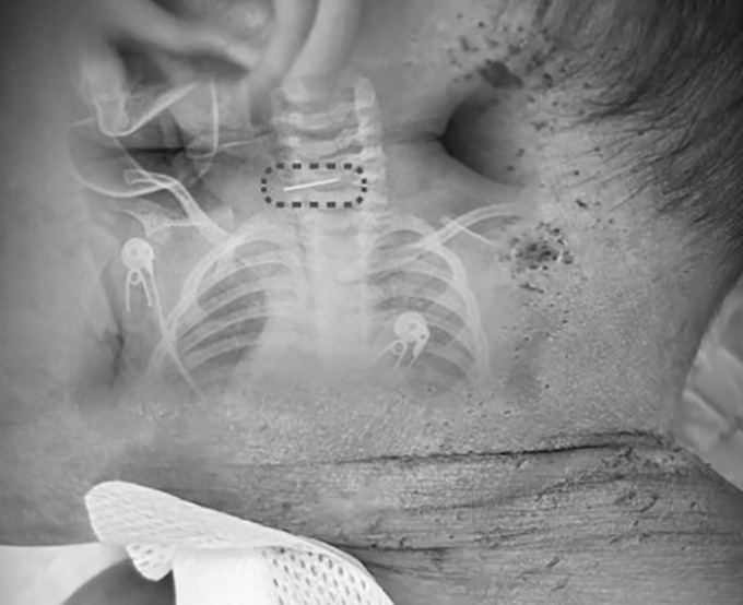 Bé trai bị sốt và co giật, bác sĩ phát hiện ra điều đáng sợ - Ảnh 1.