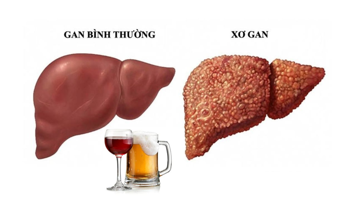 Bệnh gan tăng vọt sau Tết: Chuyên gia chỉ rõ thói quen "gánh nặng" nội tạng - Ảnh 1.