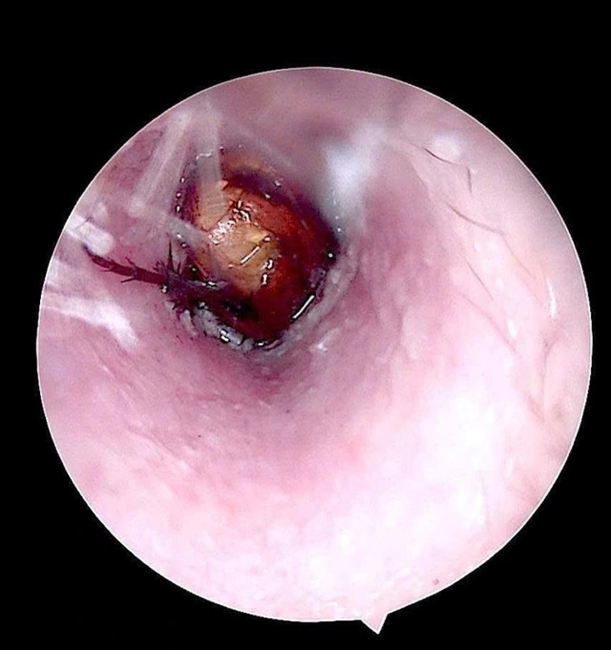 Cháu bé đau tai dữ dội, bác sĩ sốc ngang phát hiện bí mật "đáng sợ" bên trong - Ảnh 1.