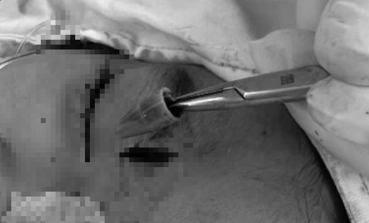 Bé trai đau vùng mắt dữ dội, bác sĩ sốc khi phát hiện dị vật "tàng hình" - Ảnh 1.