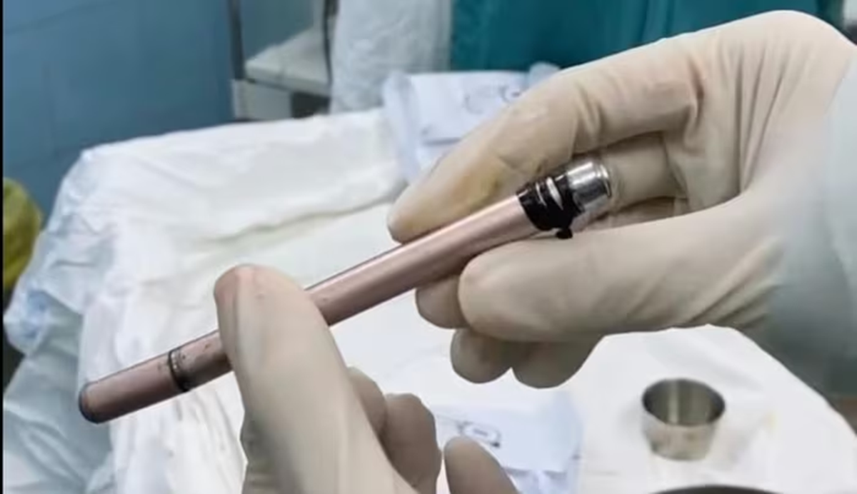 Cây bút lọt vào vùng kín, cô gái 16 tuổi hoang mang nhập viện trong đêm - Ảnh 1.