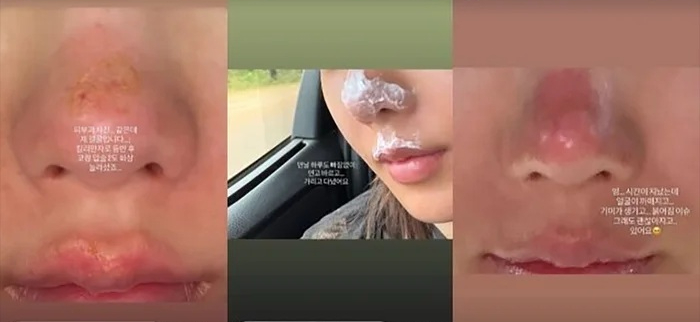 Nữ ca sĩ bị bỏng da độ 2 khi leo núi, khiến fan bàng hoàng - Ảnh 1.