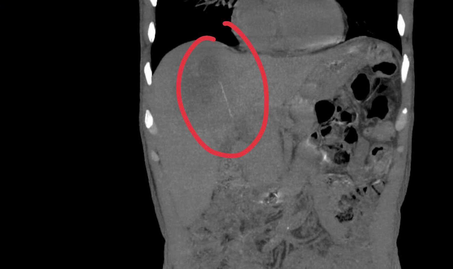 Người đàn ông đau bụng kéo dài, bác sĩ sốc khi phát hiện bí mật bên trong - Ảnh 2.