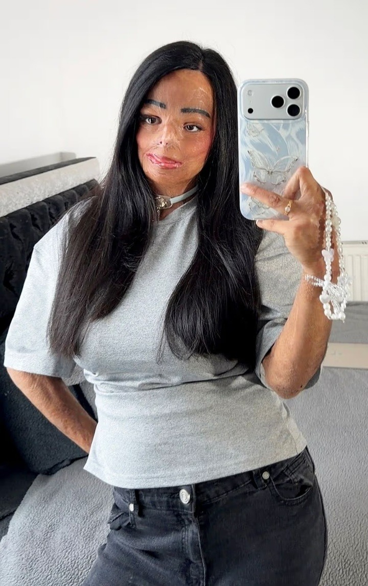 Dầu gội đầu bắt lửa, cô gái xinh đẹp bị bỏng nửa người và cái kết bất ngờ- Ảnh 1.