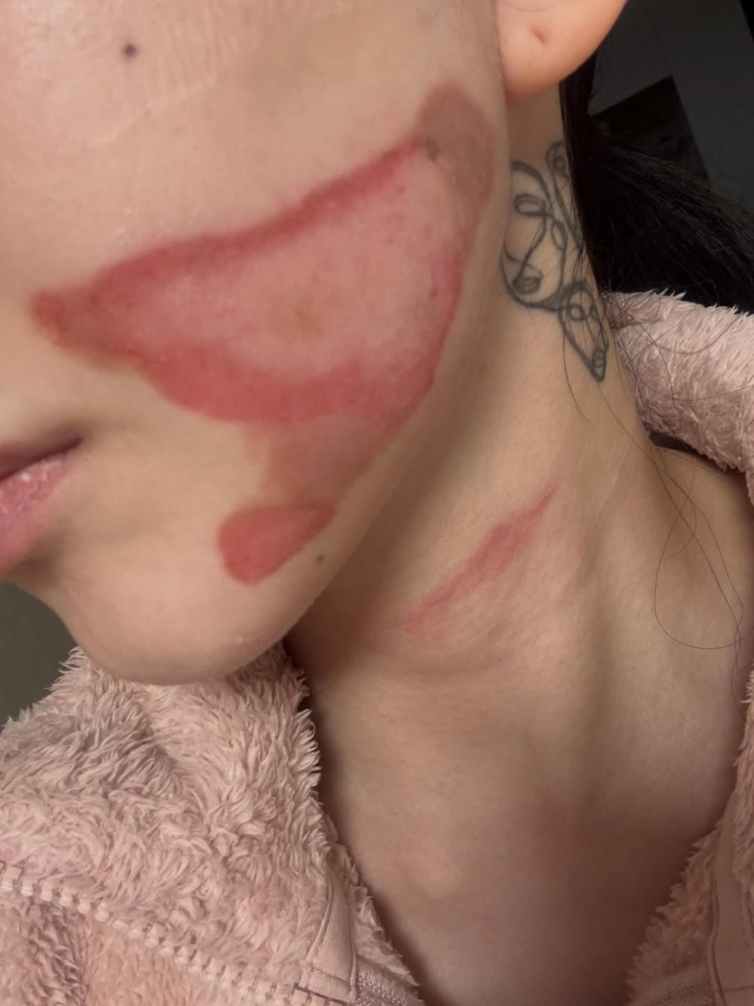 Hậu thẩm mỹ, gương mặt của nữ ca sĩ 33 tuổi bị bỏng nghiêm trọng - Ảnh 2.