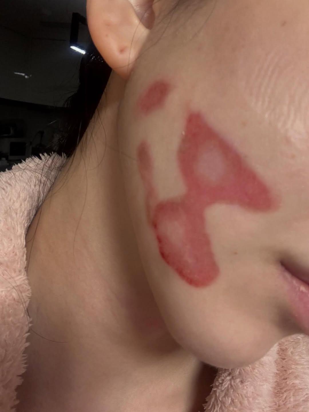 Hậu thẩm mỹ, gương mặt của nữ ca sĩ 33 tuổi bị bỏng nghiêm trọng - Ảnh 1.