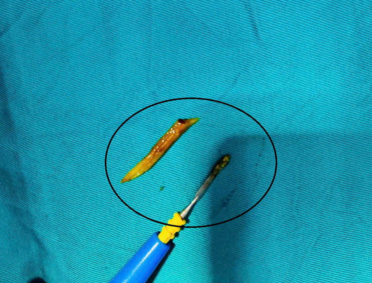 Người đàn ông 41 tuổi đau bụng, bác sĩ sốc phát hiện ra thứ đáng sợ "đi lạc" trong bụng - Ảnh 1.