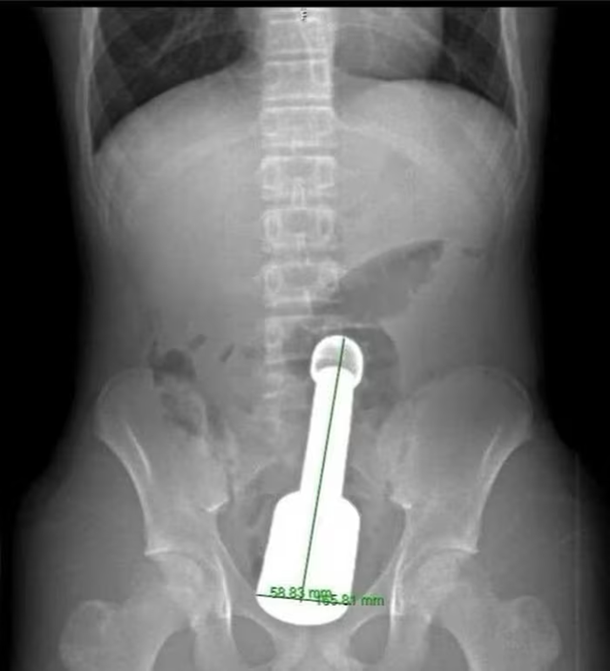 Nam thanh niên 15 tuổi đau bụng dữ dội, bác sĩ gắp ra thứ "đáng sợ" bên trong  - Ảnh 1.